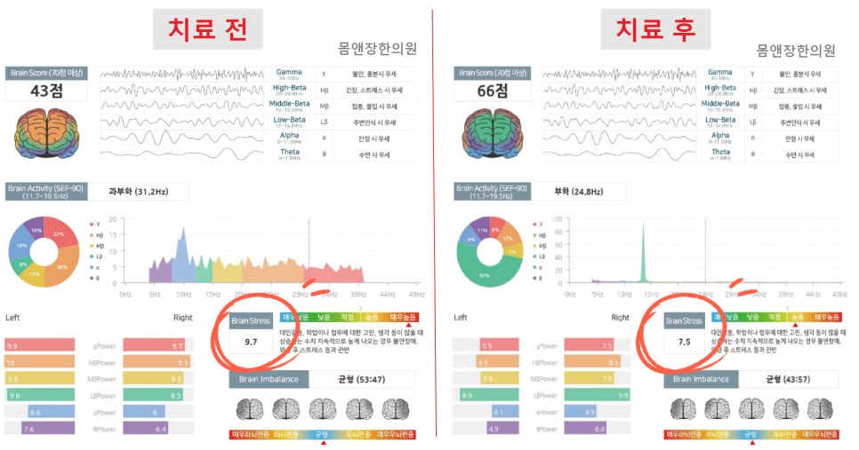 치료 전 : 23.12.20 치료 후 : 24.04.05 치료 : 침, 한약*두근거림, 어지럼증, 속 쓰림 등의 부작용이 발생할 수 있습니다.