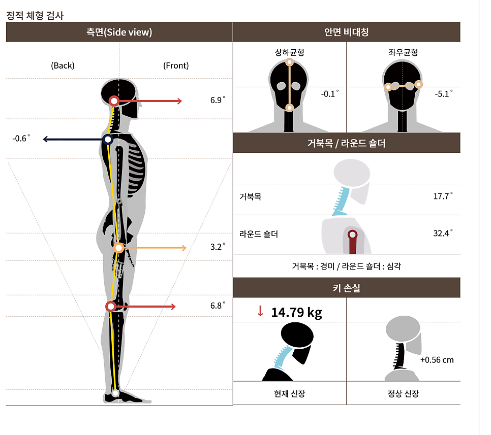 아이밸런스 거북목검사