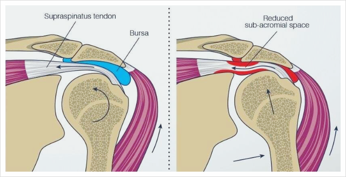 정상 어깨 vs 어깨 충돌 증후군출처: A CASE REPORT ON EFFECTIVENESS OF SPENCER TECHNIQUE ON PAIN, ROM, AND DISABILITY IN A SUBJECT WITH SHOULDER IMPINGEMENT SYNDROME - Roshni Devaiah M. 등