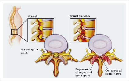 척추관 협착출처: Percutaneous Endoscopic Lumbar Spine Surgery for Lumbar Disc Herniation and Lumbar Spine Stenosis: Emphasizing on Clinical Outcomes of Transforaminal Technique - Singh Ratish ​