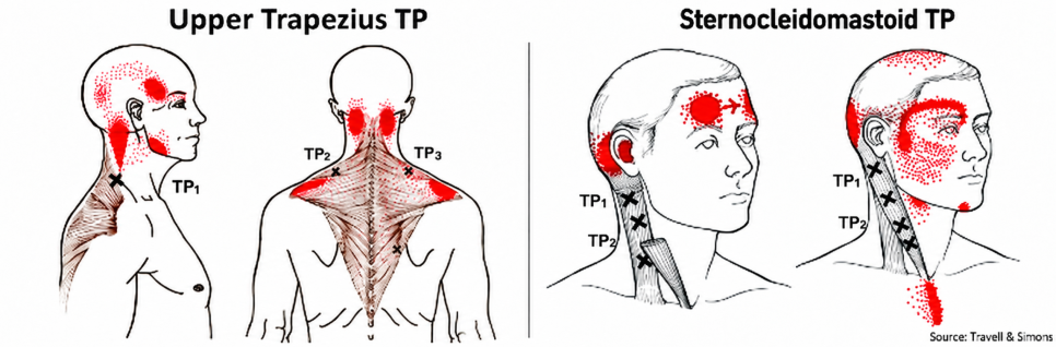출처: Myofascial Pain and Dysfunction: The Trigger Point Manual — Travell & Simons