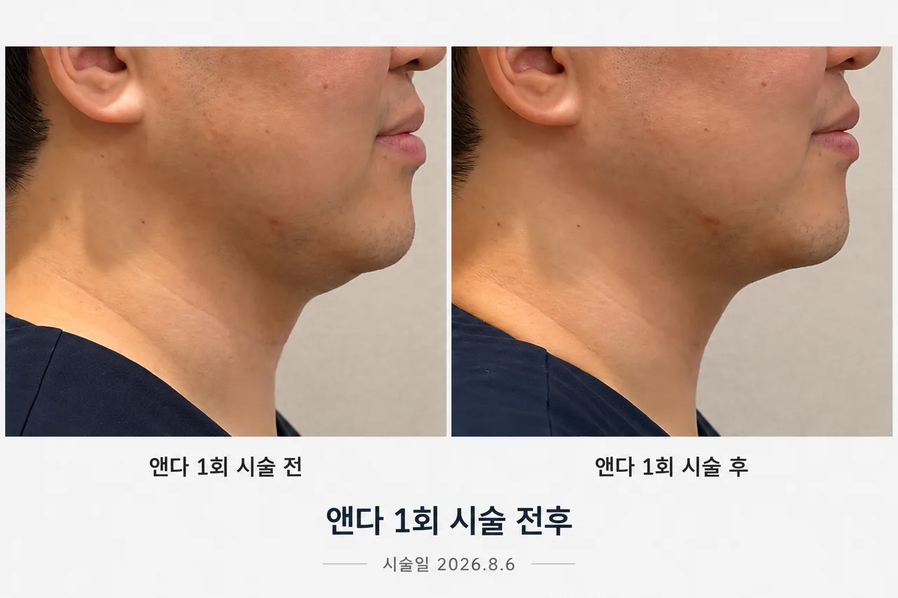 앤다시술 전후2.png