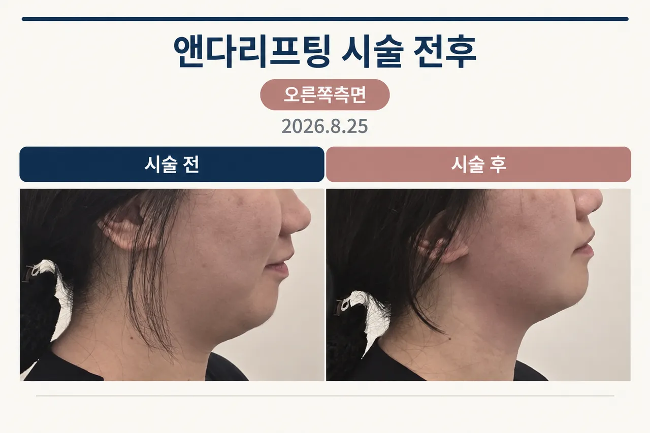 앤다시술 전후1.png