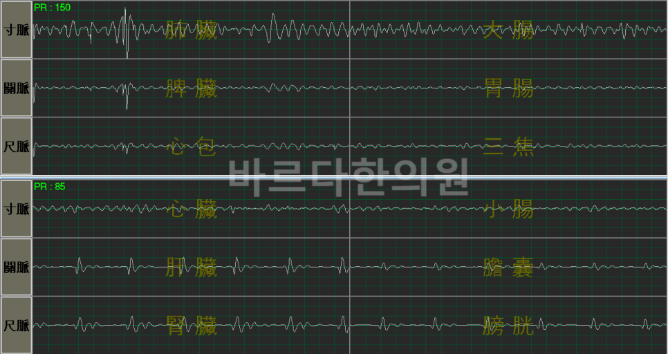 근력이 감소하고 힘이 떨어져 운동성이 떨어진 케이스 (맥진기 검사 결과).png