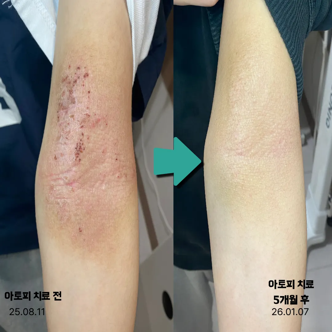 낫지 않는 피부질환. 바뀔 수 있습니다.