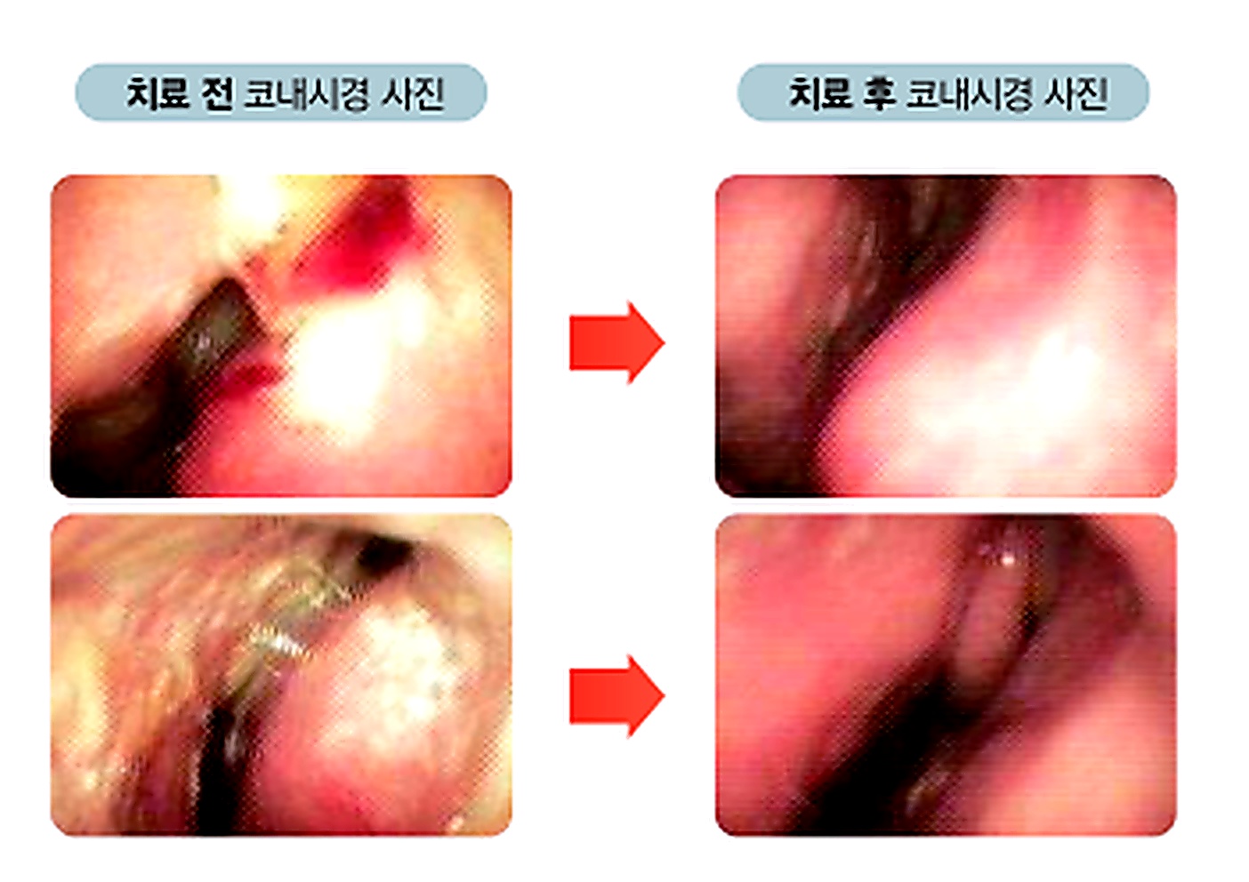 환절기마다 반복되는 비염
탈출할 수 있습니다.