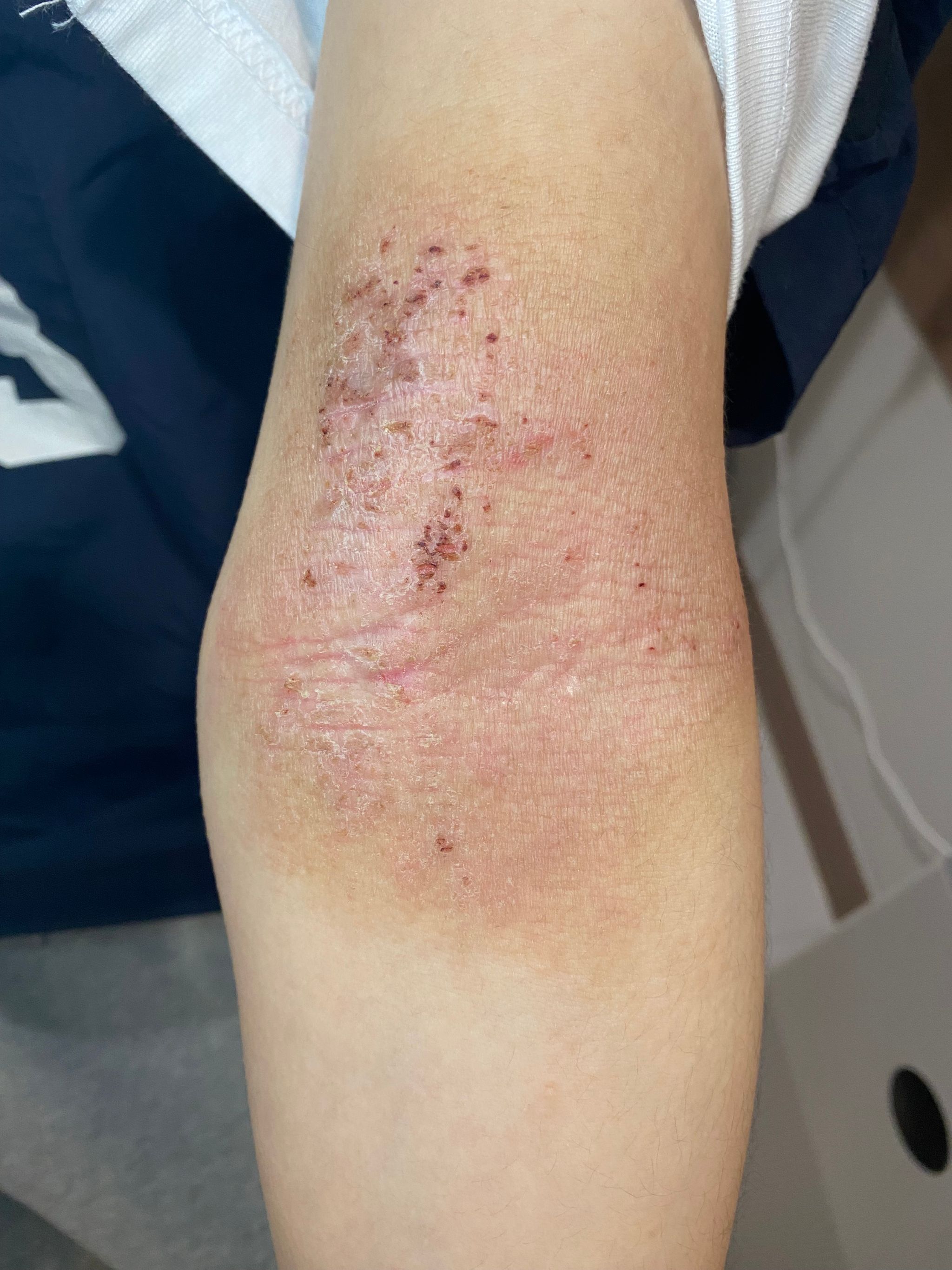 아토피, 피부질환
나을 수 있습니다