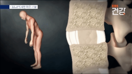 후방섬유륜손상.gif